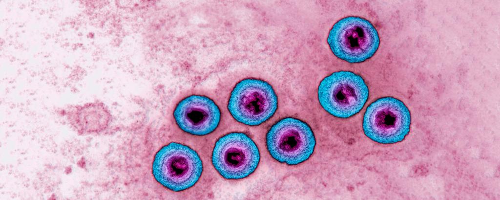 la clasificación de infecciones por herpes