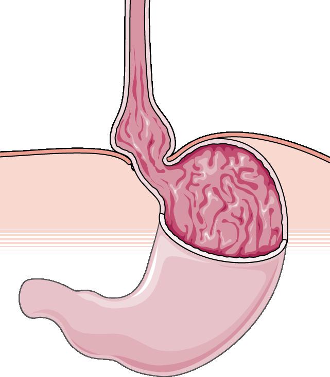 Hernia of the esophagus