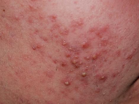 small red pimples on the face