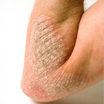 psoriasis causes pictures