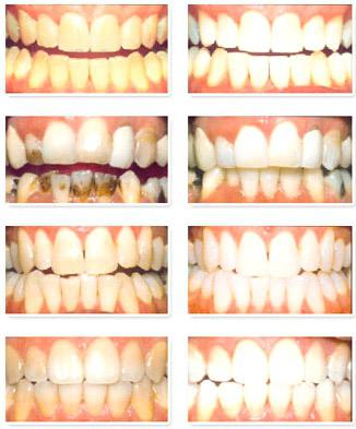 teeth Whitening in dentistry: prices, reviews