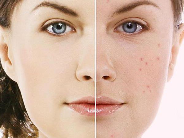 antibiotic for acne on face tablet