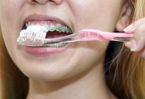 Platte zur Ausrichtung der Zähne: Bewertungen von Zahnärzten und Patienten
