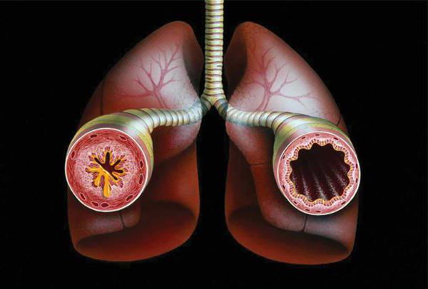астма прычыны ўзнікнення