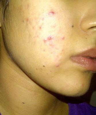 differin for acne