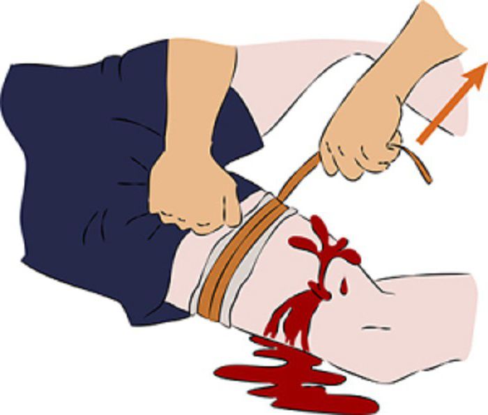 arterial and venous bleeding first aid