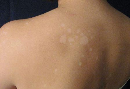 white spots on skin tanning