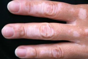 weiße Flecken auf der Haut der Hände