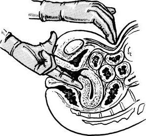 bimanuelle Untersuchung des Uterus