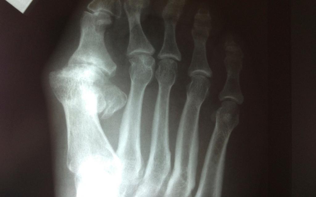 Diagnóstico de artrite nos dedos dos pés