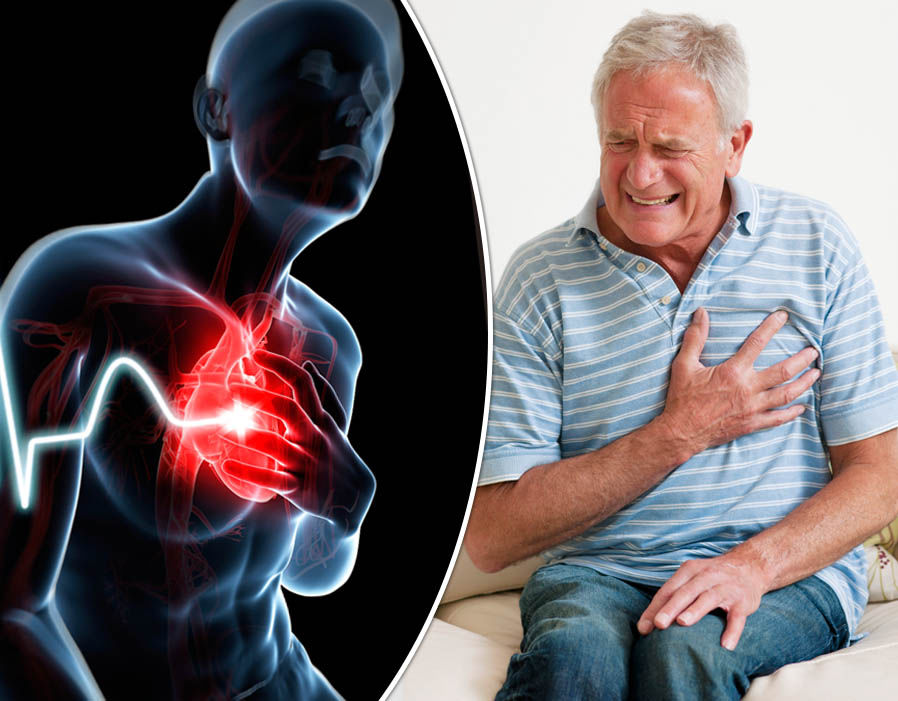 signos de infarto de miocardio