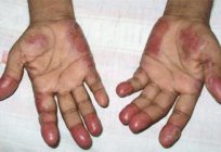Necrobiosis lipoidica: الأسباب والأعراض والتشخيص والعلاج
