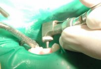 الأسنان السد. استخدام المطاط السد في طب الأسنان