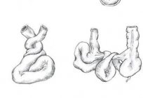 Bowl Kloybera x-ray examination of the abdominal cavity