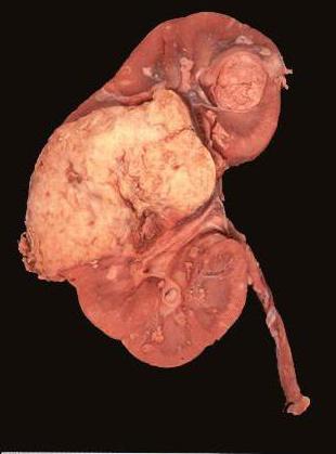 angiomyolipoma kidney threat for life