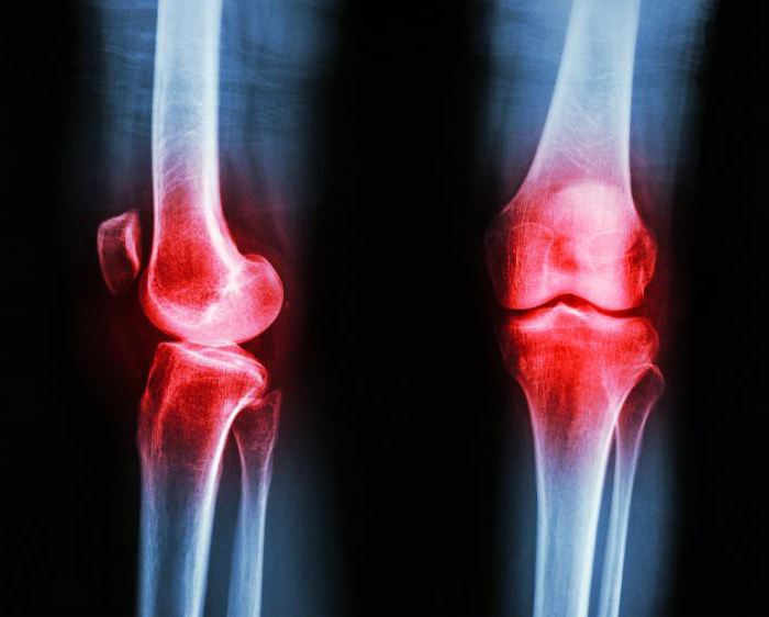 операція по заміні колінного суглоба