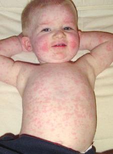 皮疹在身体中的儿童