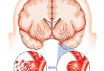 A minor stroke: implications, symptoms and treatment