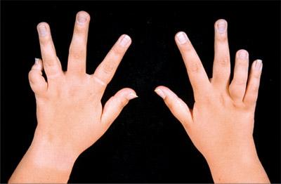 treatment of arthritis of the hands