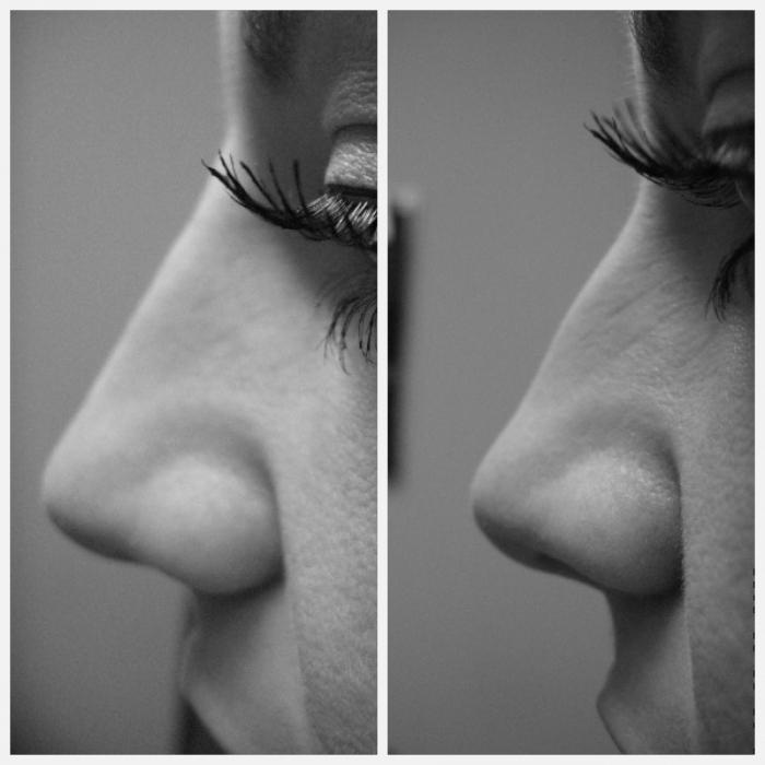 tipos de formas de nariz