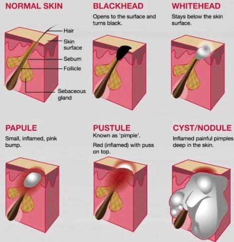 el acné en los testículos