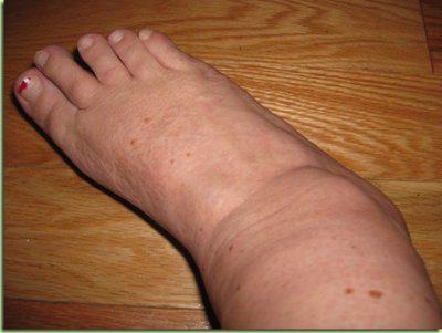 elephantiasis足の写真
