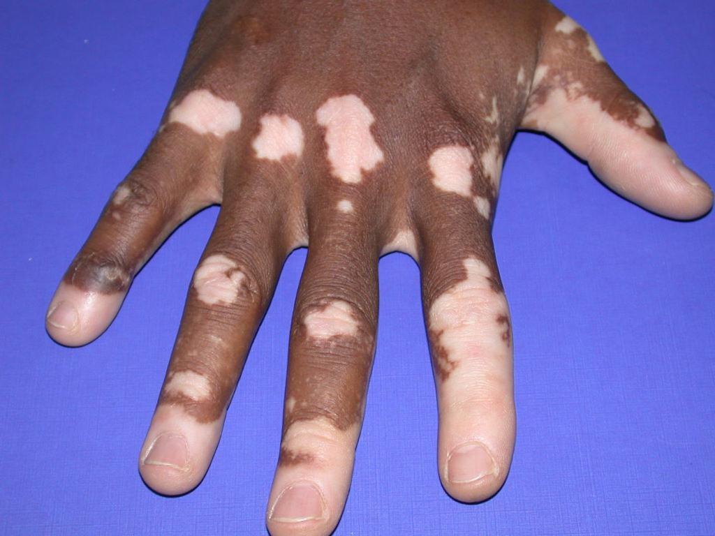 त्वचा Pigmentation में एडिसन रोग