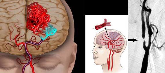 Profilaktyka udaru mózgu u kobiet