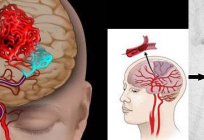 El ictus cerebral: la prevención. Los remedios caseros para la prevención del ictus