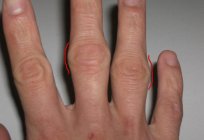 取り扱いについて定められた民間療法関節の炎症の指
