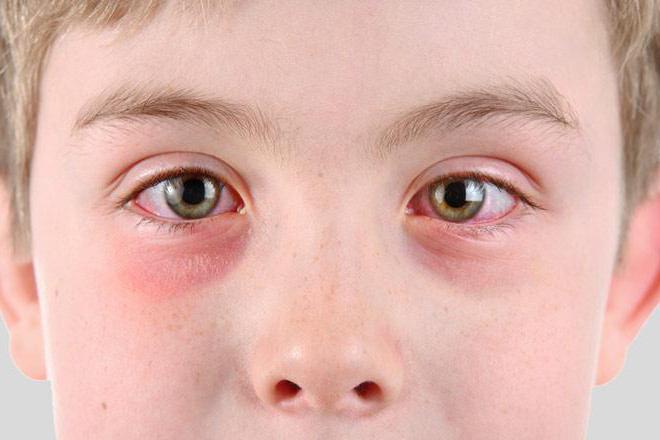 एलर्जी नेत्रश्लेष्मलाशोथ लक्षण