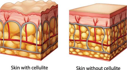 el tratamiento de la celulitis