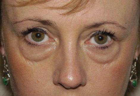 transconjuctival blepharoplasty eyelid