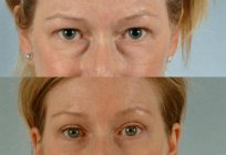 Transconjunctival blepharoplasty is performed: description, indication, complications and reviews