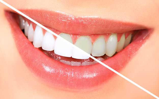 fluoridation के दांत यह क्या है