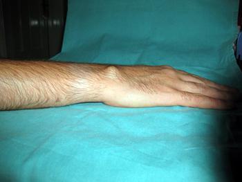 नाड़ीग्रन्थि पुटी कलाई उपचार सर्जरी के बिना