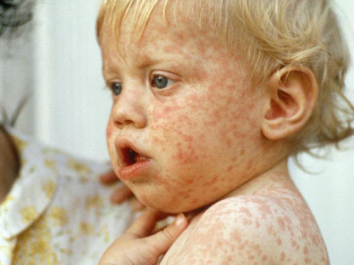 病気の麻疹の写真