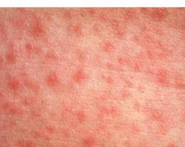 childhood disease measles