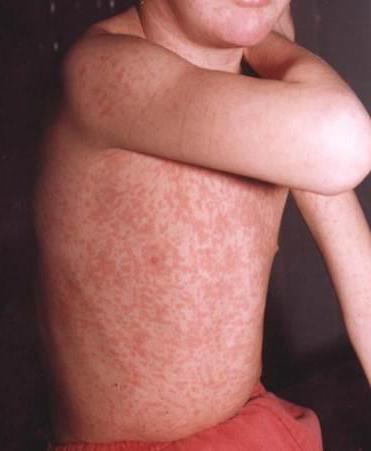 measles infectious diseases