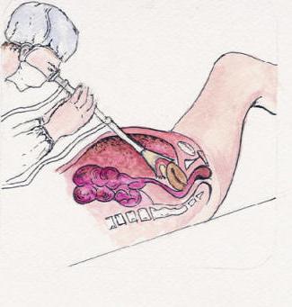 френикус sintoma em ginecologia