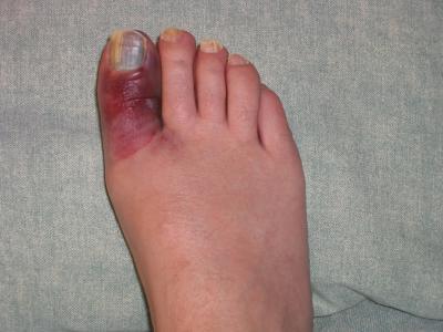 ferimento de dedos no pé