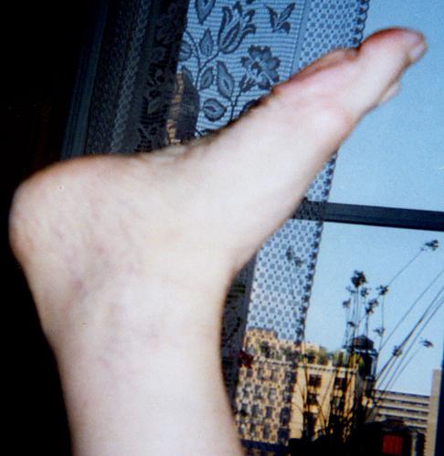 a lesão do dedo grande do pé