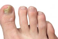 Wild meat near the nail: treatment, causes and ways of solving problems