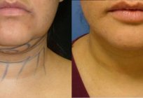 Chin up: plastic, before and after photos