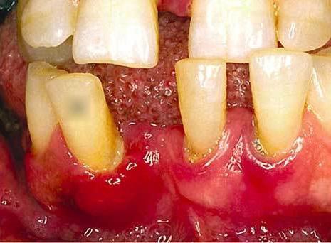 के कारण periodontitis
