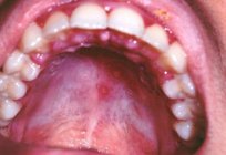 Czym leczy się zapalenie jamy ustnej u dzieci, przyczyny jego pojawienia się