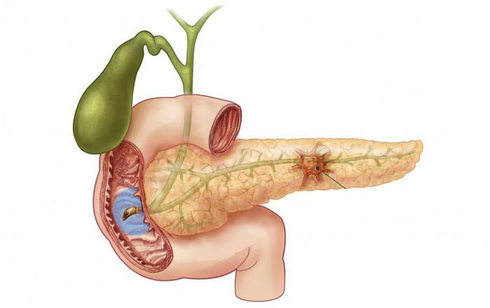 um tumor no pâncreas sintomas
