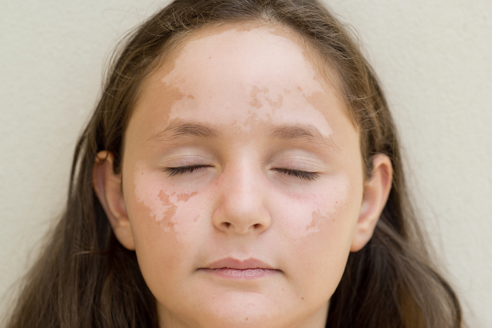el vitiligo que es por la enfermedad de la