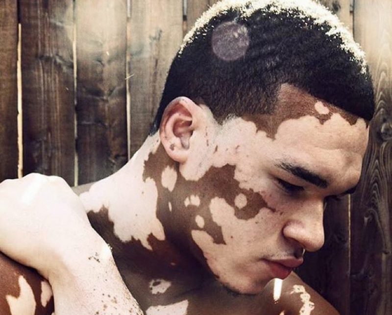 vitiligo çocuklarda