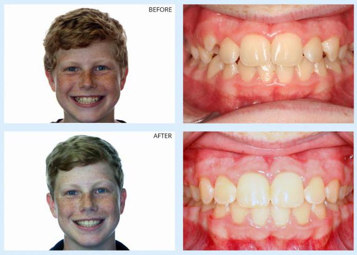 जुदाई के दांत से पहले और बाद में फोटो